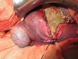 Pictures of Laparoscopic Liver Cyst Surgery Recovery