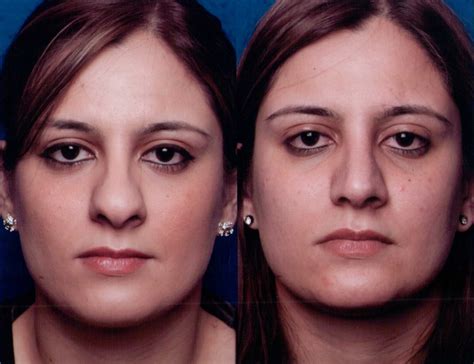 The Nose Clinic Before And After Nose Surgery Photos 53