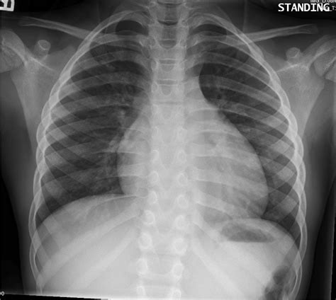 It has not had the test characteristics that were originally anticipated because calcification of the arterial walls is not. Chest X-Ray Challenge! - PEMBlog