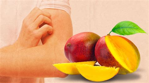 Mysteries Of Mango Allergy Causes Symptoms And Treatment Postartica