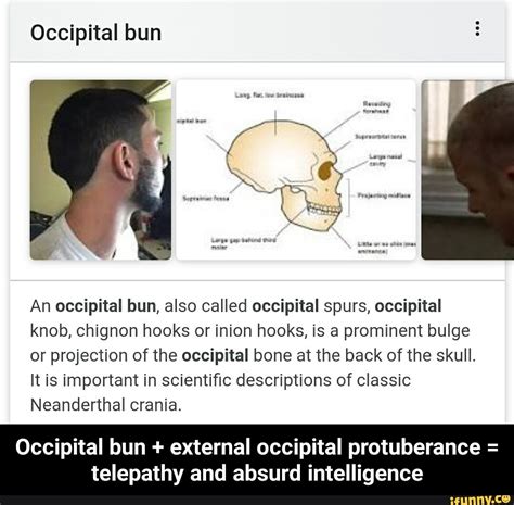 Occipital Bun An Occipital Bun Also Called Occipital Spurs Occipital