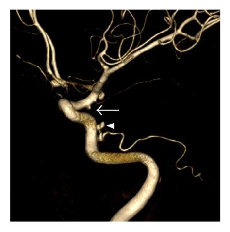 A Three Dimensional Digital Subtraction Angiography Shows Left Download Scientific Diagram