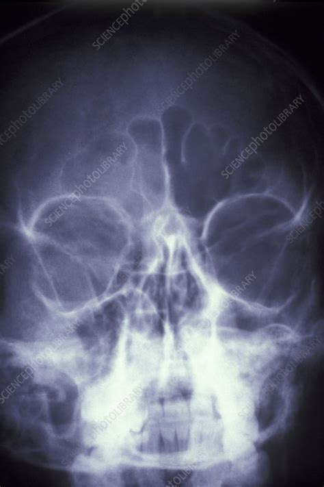 Infected Frontal Sinus X Ray Stock Image M2600405 Science Photo