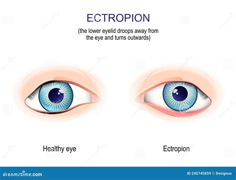 Ectropion The Lower Eyelid Droops Away From The Eye And Turns Outwards