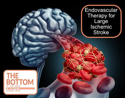Endovascular Therapy For Large Ischemic Stroke The Bottom Line