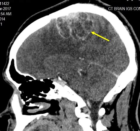 Microcystic Meningioma Radiology Cases