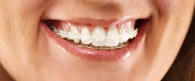 How To Get White Teeth With Braces In One Day How To Get Your Teeth