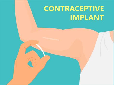 Birth Control Implant Nexplanon Risks And Side Effects