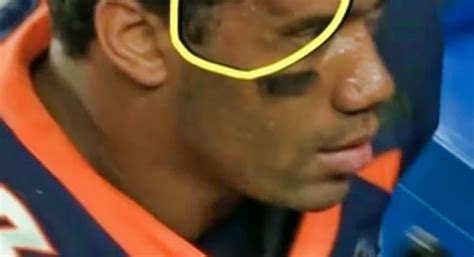 Russell Wilson Spotted With Disgusting Bump On His Head After Being Ko