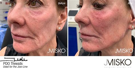 The Best 26 Pdo Thread Lift Jawline Before And After Aboutblockgraphics