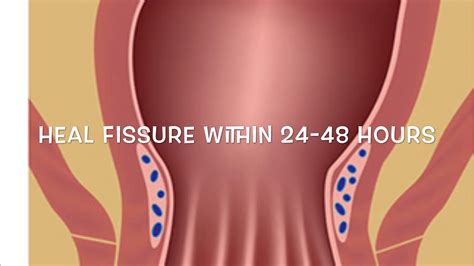 Cure Fissure At Home Works YouTube