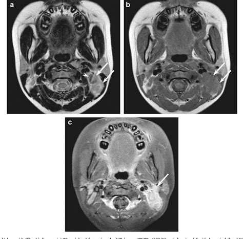 Figure 1 From Mr Imaging Findings Of Cervical Lymphadenopathy In