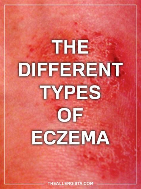 The Different Types Of Eczema Eczema Symptoms Eczema Remedies
