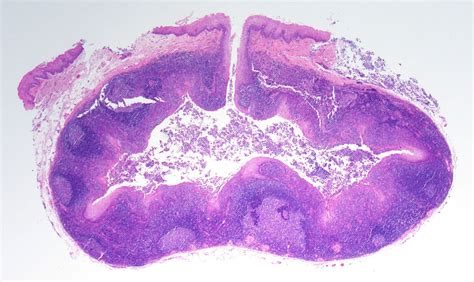 Pathology Outlines Lymphoepithelial Cyst
