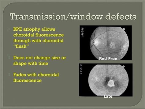 Basic Info On Fudus Florescence Angiography