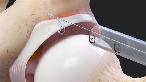 Arthrex Revision Acetabular Labral Repair Using The Knotless Hip