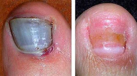 How To Take Care Of Exposed Nail Bed