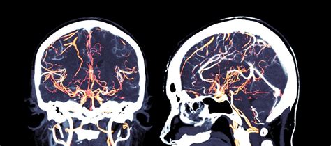 Brain Imaging Neuroimaging I Med Radiology Network