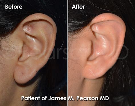 Earlobe Reduction Photos Before And After Dr James Pearson Facial