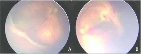 Representative Fundus Images Fig 1 Shows The Fundus Images Of Human