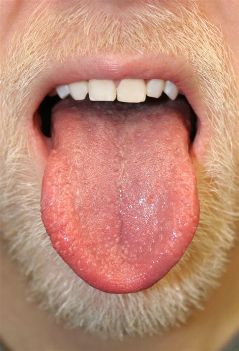 White Spots On Tongue White Spots On Tongue Bumps Patches Painful