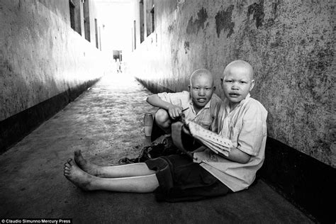 Tanzanias Albino Community Fear Being Killed For Their Body Parts For