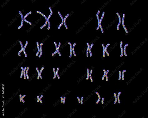 Patau Syndrome Karyotype Male Or Female Unlabeled Trisomy D The Best Porn Website