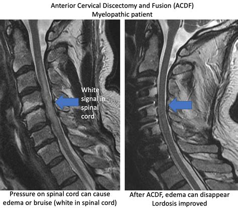 Anterior Cervical Discectomy And Fusion Acdf Rocky Mountain Brain