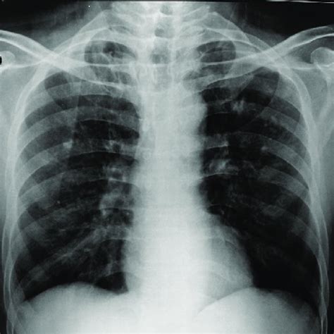 Follow Up Chest X Ray At The End Of 2 Months Showing Only Blunting Of