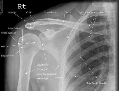 Top Photos in Shoulder Joint X-Ray