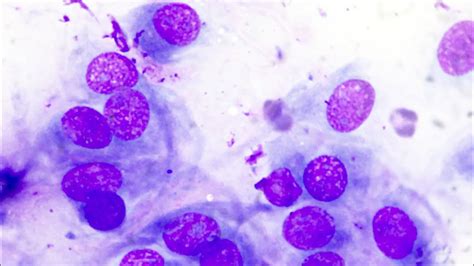 Small Cell Carcinoma Cytology