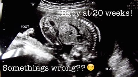 20 Weeks Pregnant Ultrasound Something Isnt Right Youtube