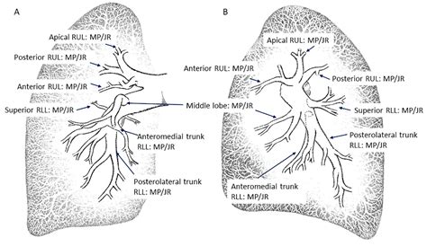 Pulmonary Artery Tree