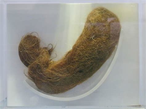 Human Hairball Picture Of National Museum Of Health And Medicine