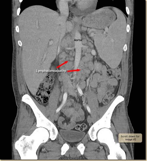 Abdominal And Pelvic Ct Scan With Oral And Iv Contrast