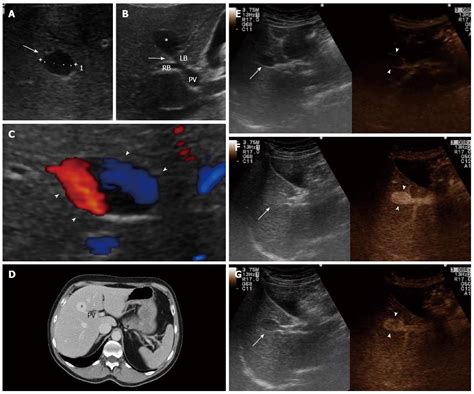 contrast enhanced ultrasound  portal venous system aneurysms  multi