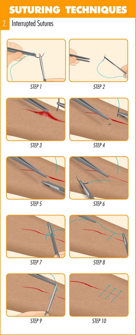 Application generally involves using a needle with an attached length of thread. Complete Guide to Mastering Suturing Techniques