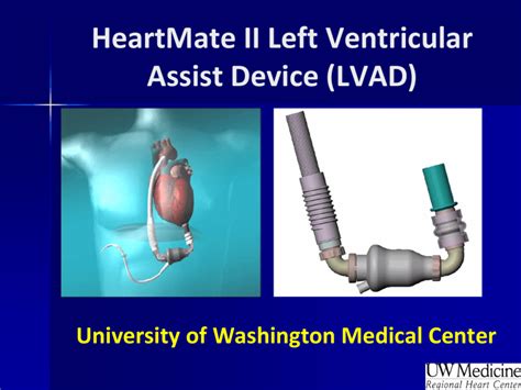 Heartmate Ii Left Ventricular Assist Device Lvad Pivotal Trial