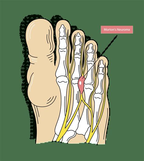 Morton S Neuroma Treatment Symptoms And Causes The Foot Hub