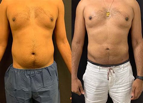 Before And After Male Liposuction Results Neinstein Plastic Surgery