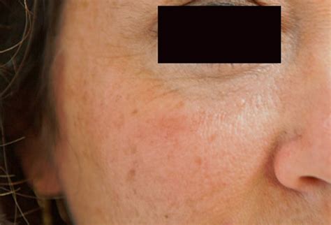 Dry Patches On Face Pictures Causes Remedies Treatment