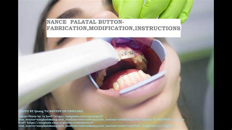 Nance Palatal Arch Uses Fabrication Modification In Orthodontics