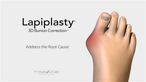 LAPIPLASTY® System | Treace Medical Concepts, Inc.How the Lapiplasty