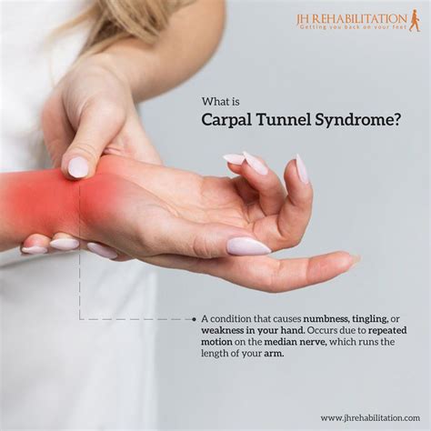 Pin By Ahbab Hashem On Physiotherapy Carpal Tunnel Syndrome Median Nerve Carpal Tunnel