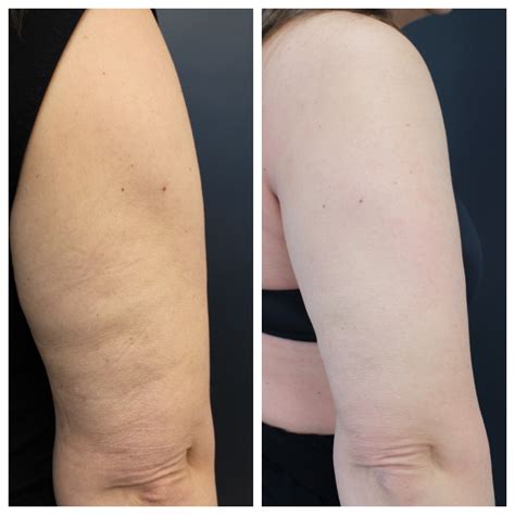Best Skin Cellulite And Butt Dimples Treatment Los Angeles And Santa Monica Dr Tanya Kormeili