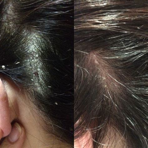 What Does Psoriasis Look Like On The Scalp What Does