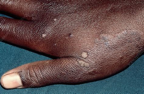Warts Stock Image C0583634 Science Photo Library
