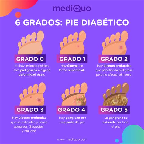 Grado del pie diabético Pie diabetico Pie diabetico imagenes Salud de los pies
