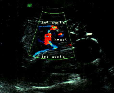 Case Report Conjoined Twins Thoraco Omphalopagus Type A