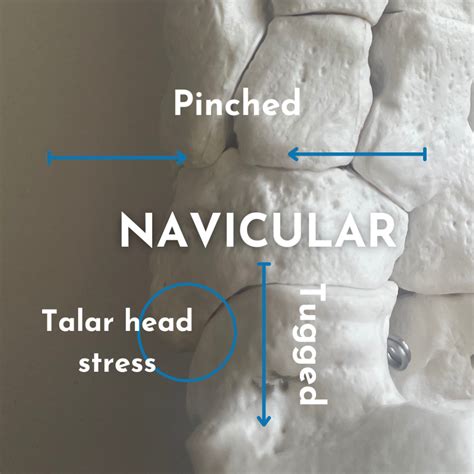 Navicular Stress Fracture Essentials Nathan Carlson Running Mate